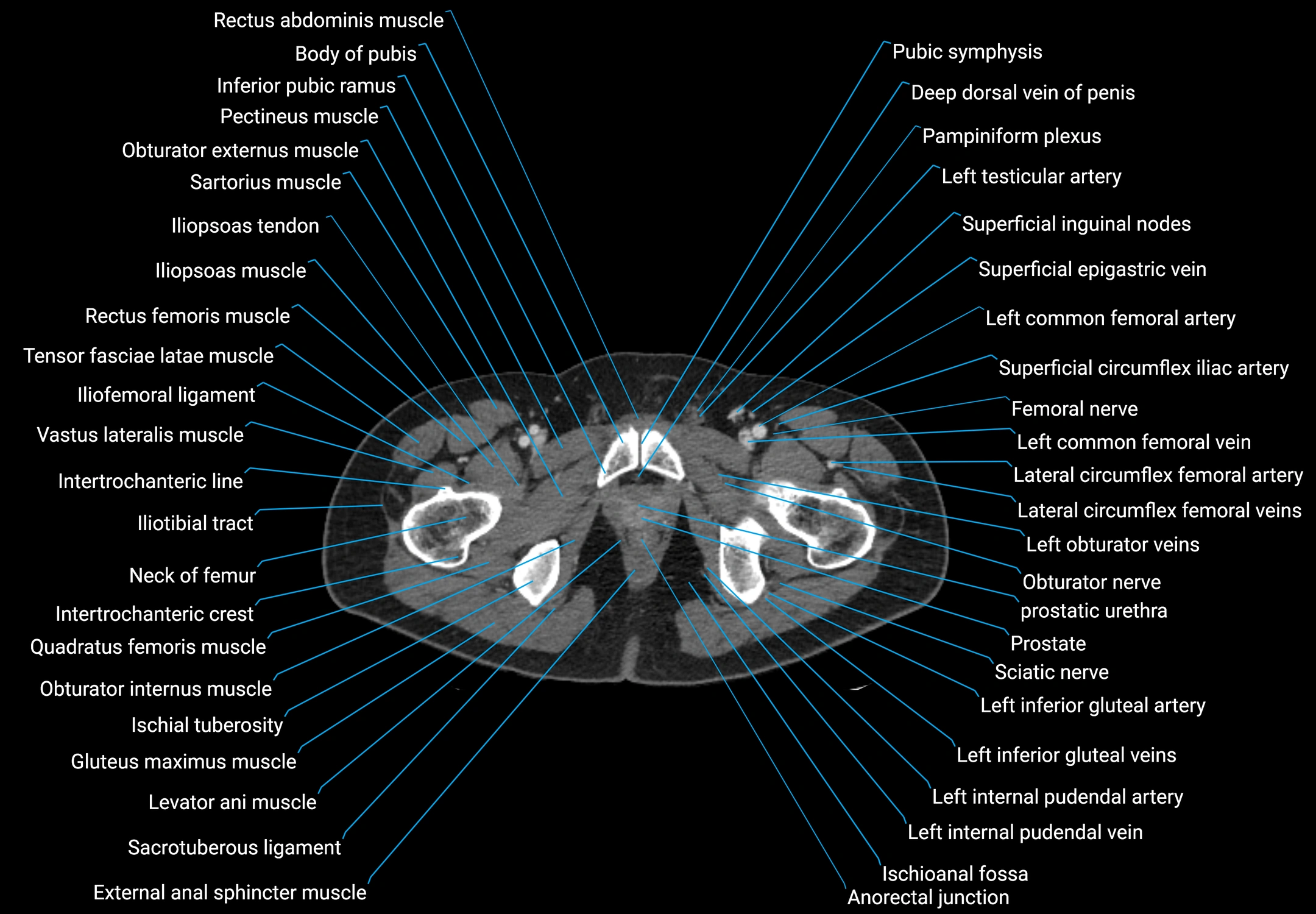 CT male pelvis axial cross sectional anatomy labelled radiology image -00201.webp